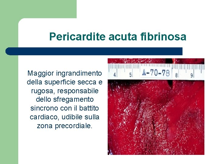 Pericardite acuta fibrinosa Maggior ingrandimento della superficie secca e rugosa, responsabile dello sfregamento sincrono