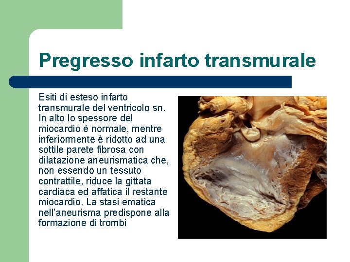 Pregresso infarto transmurale Esiti di esteso infarto transmurale del ventricolo sn. In alto lo