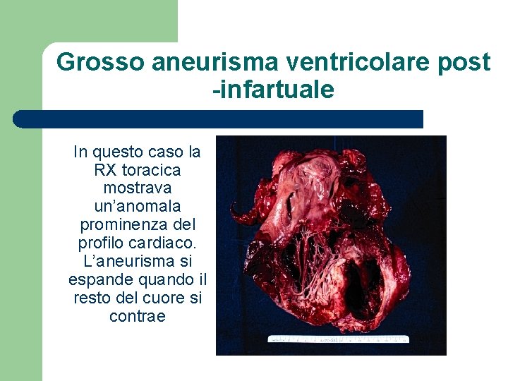 Grosso aneurisma ventricolare post -infartuale In questo caso la RX toracica mostrava un’anomala prominenza