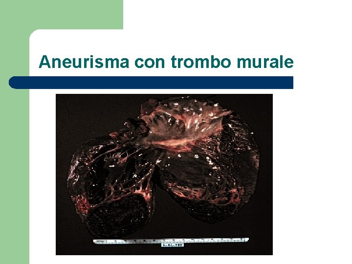 Aneurisma con trombo murale 