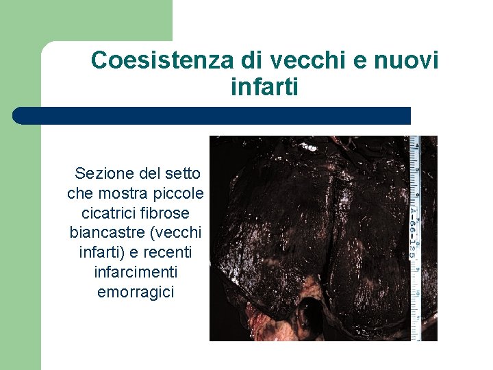 Coesistenza di vecchi e nuovi infarti Sezione del setto che mostra piccole cicatrici fibrose