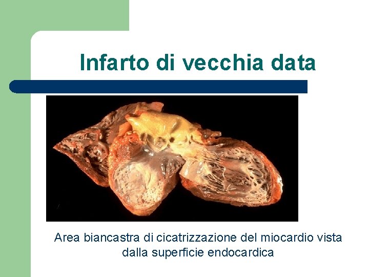 Infarto di vecchia data Area biancastra di cicatrizzazione del miocardio vista dalla superficie endocardica