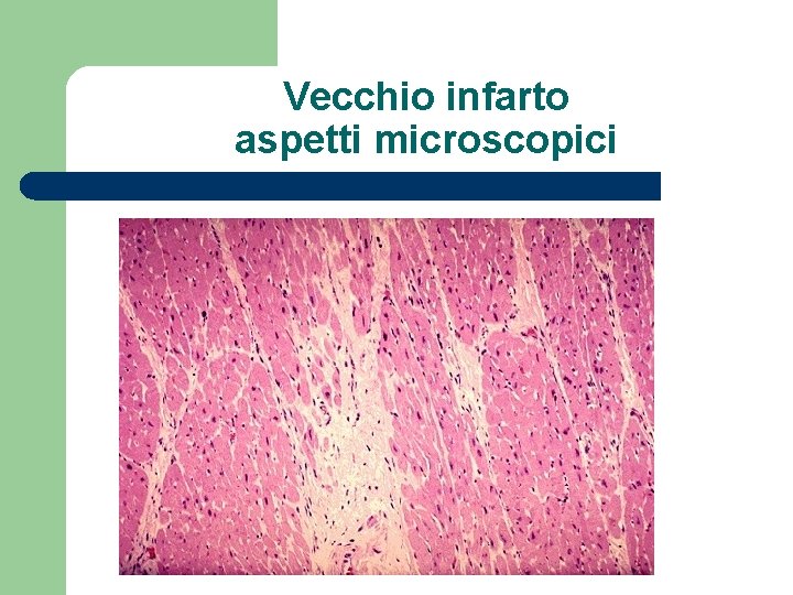 Vecchio infarto aspetti microscopici 