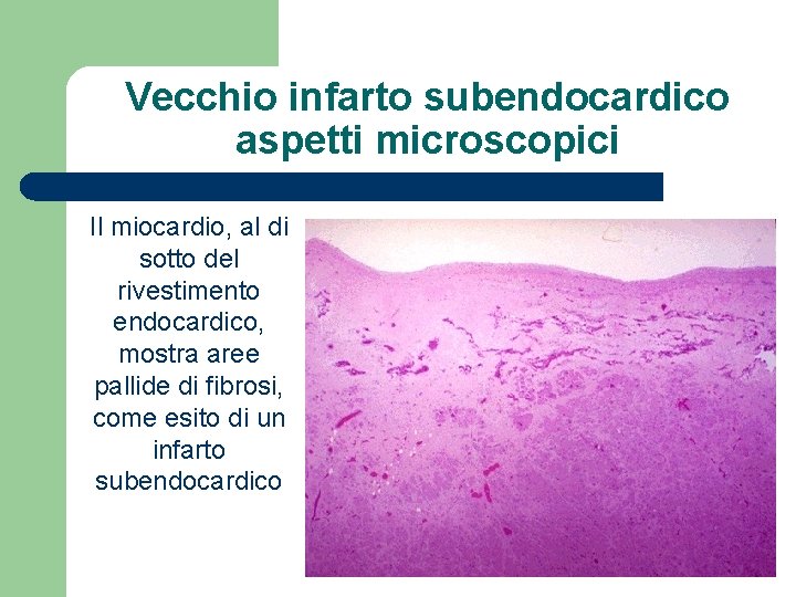 Vecchio infarto subendocardico aspetti microscopici Il miocardio, al di sotto del rivestimento endocardico, mostra