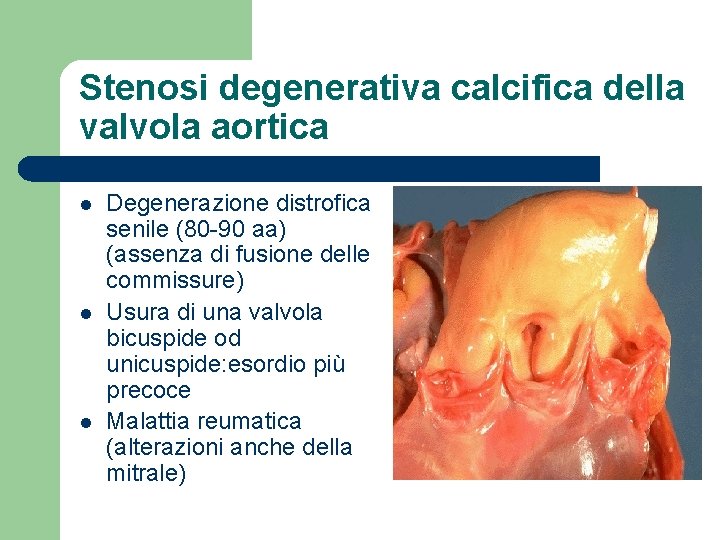 Stenosi degenerativa calcifica della valvola aortica l l l Degenerazione distrofica senile (80 -90