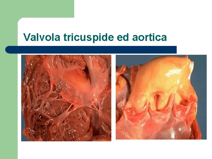 Valvola tricuspide ed aortica 