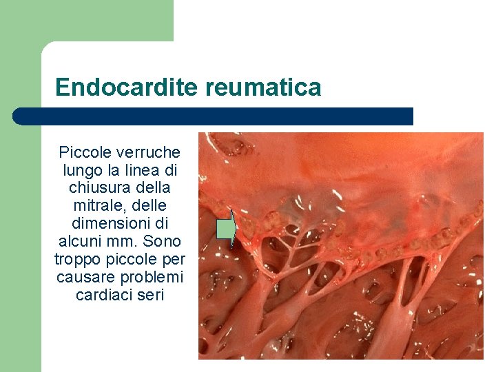 Endocardite reumatica Piccole verruche lungo la linea di chiusura della mitrale, delle dimensioni di