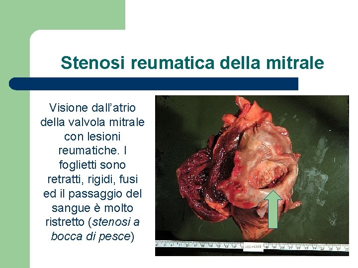 Stenosi reumatica della mitrale Visione dall’atrio della valvola mitrale con lesioni reumatiche. I foglietti