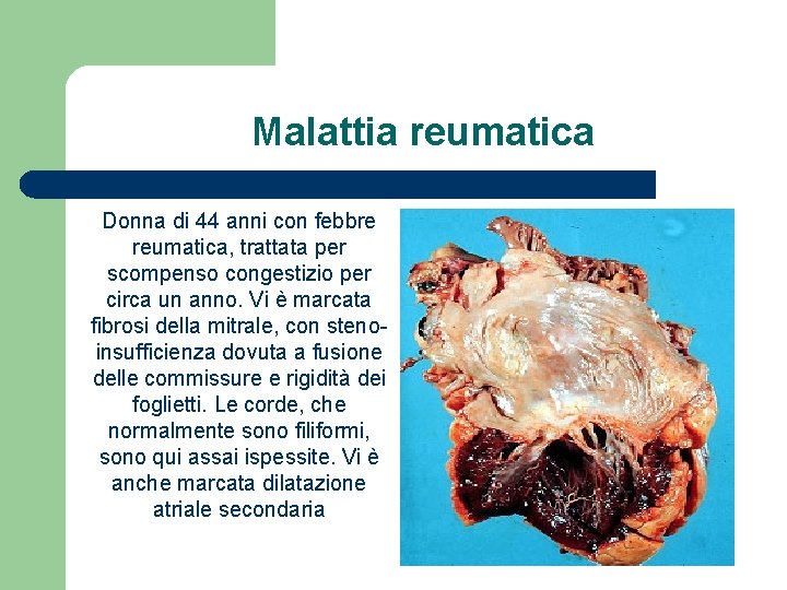 Malattia reumatica Donna di 44 anni con febbre reumatica, trattata per scompenso congestizio per