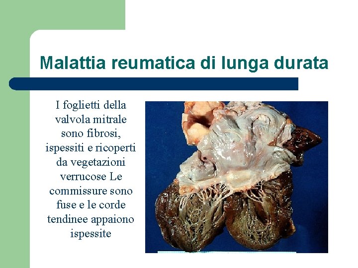 Malattia reumatica di lunga durata I foglietti della valvola mitrale sono fibrosi, ispessiti e