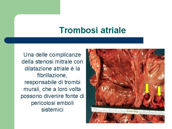 Trombosi atriale Una delle complicanze della stenosi mitrale con dilatazione atriale è la fibrillazione,