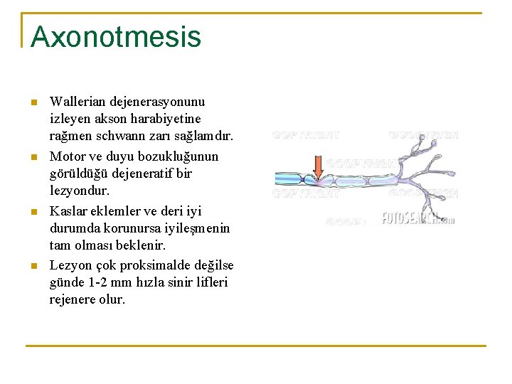 Axonotmesis n n Wallerian dejenerasyonunu izleyen akson harabiyetine rağmen schwann zarı sağlamdır. Motor ve