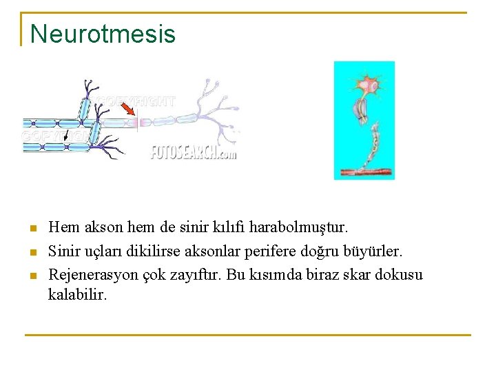 Neurotmesis n n n Hem akson hem de sinir kılıfı harabolmuştur. Sinir uçları dikilirse
