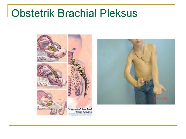 Obstetrik Brachial Pleksus 