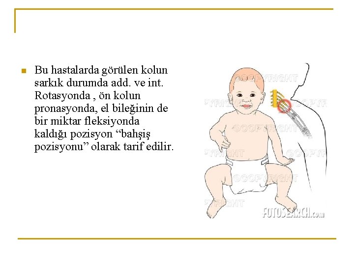 n Bu hastalarda görülen kolun sarkık durumda add. ve int. Rotasyonda , ön kolun