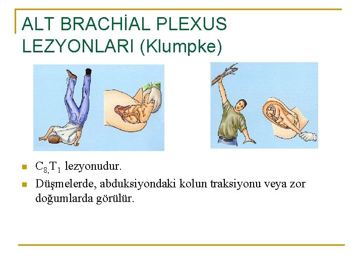 ALT BRACHİAL PLEXUS LEZYONLARI (Klumpke) n n C 8, T 1 lezyonudur. Düşmelerde, abduksiyondaki