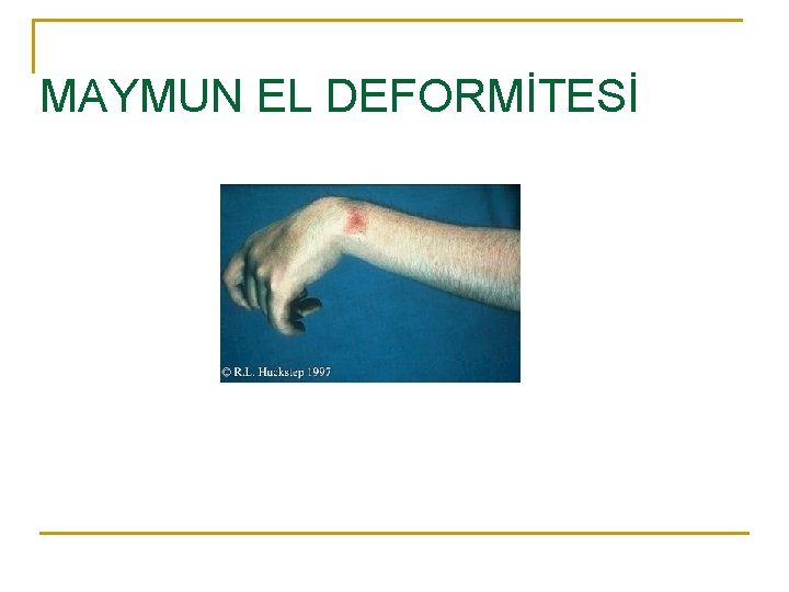 MAYMUN EL DEFORMİTESİ 