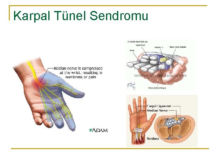 Karpal Tünel Sendromu 