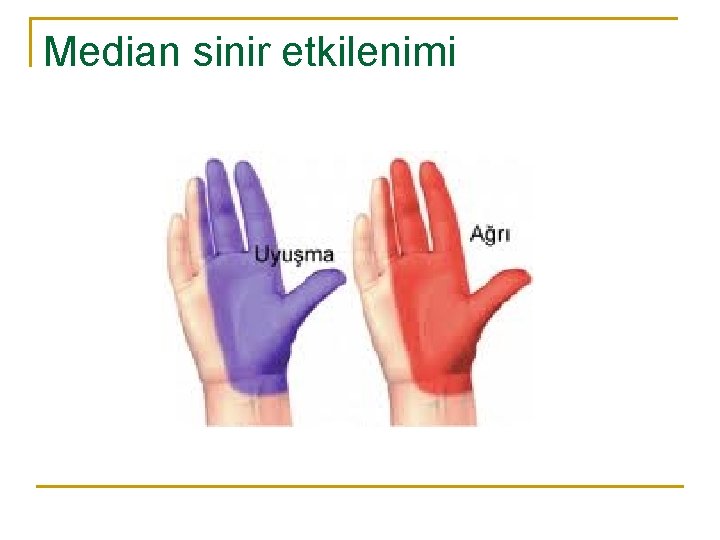 Median sinir etkilenimi 