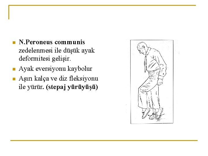 n n n N. Peroneus communis zedelenmesi ile düşük ayak deformitesi gelişir. Ayak eversiyonu