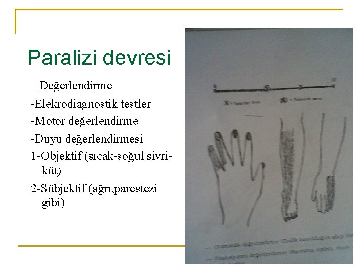 Paralizi devresi Değerlendirme -Elekrodiagnostik testler -Motor değerlendirme -Duyu değerlendirmesi 1 -Objektif (sıcak-soğul sivriküt) 2