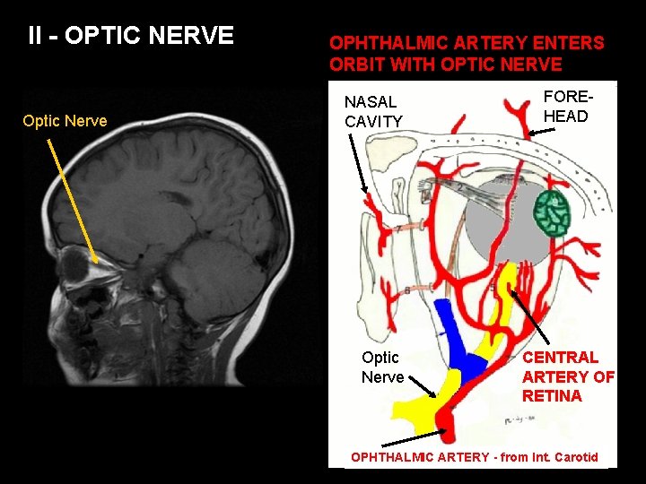 II - OPTIC NERVE Optic Nerve OPHTHALMIC ARTERY ENTERS ORBIT WITH OPTIC NERVE NASAL