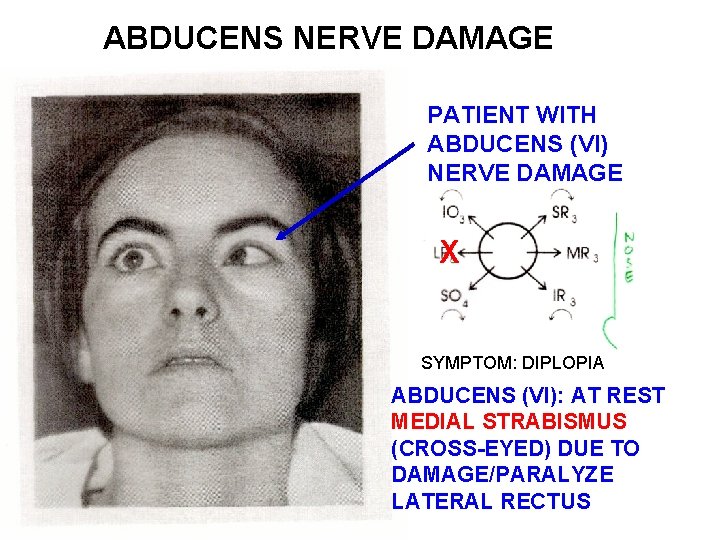 ABDUCENS NERVE DAMAGE PATIENT WITH ABDUCENS (VI) NERVE DAMAGE X SYMPTOM: DIPLOPIA ABDUCENS (VI):