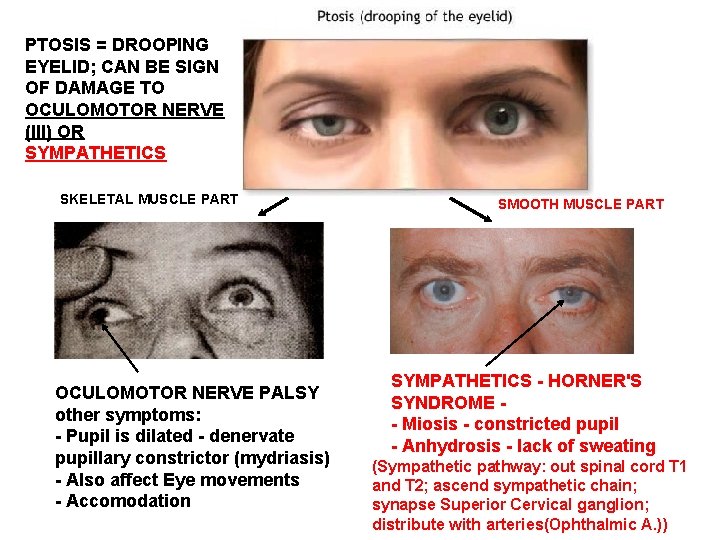 PTOSIS = DROOPING EYELID; CAN BE SIGN OF DAMAGE TO OCULOMOTOR NERVE (III) OR