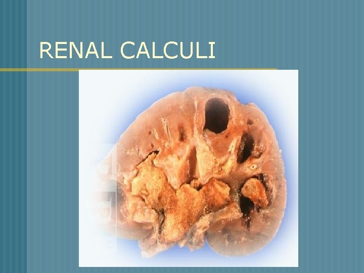 RENAL CALCULI 