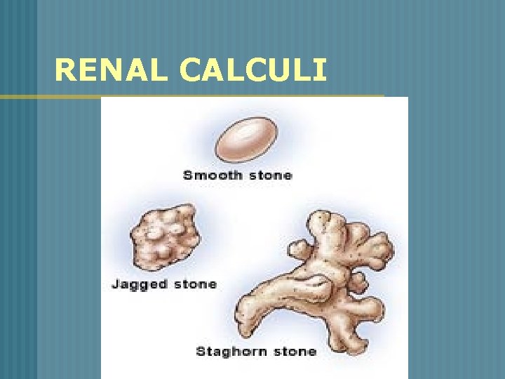 RENAL CALCULI 