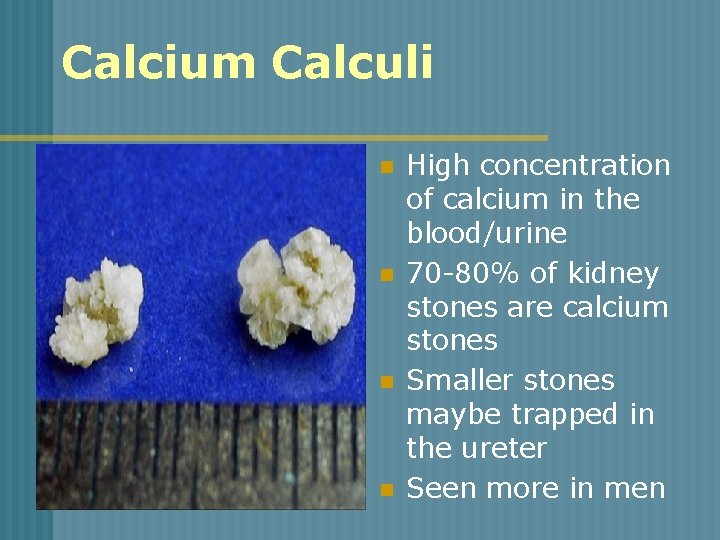 Calcium Calculi n n High concentration of calcium in the blood/urine 70 -80% of