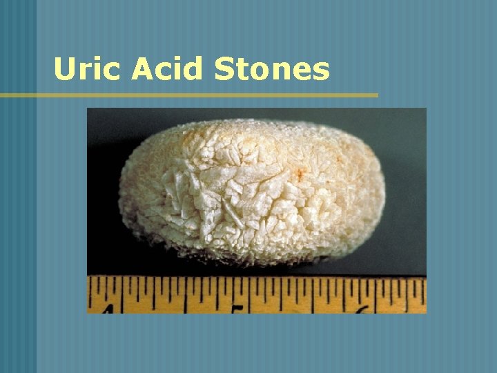 Uric Acid Stones 