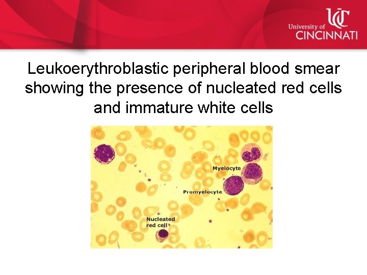 Leukoerythroblastic peripheral blood smear showing the presence of nucleated red cells and immature white