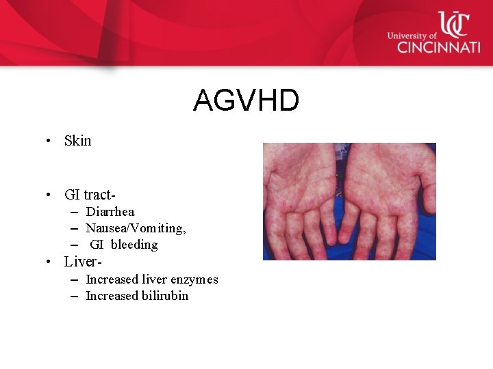 AGVHD • Skin • GI tract– Diarrhea – Nausea/Vomiting, – GI bleeding • Liver–