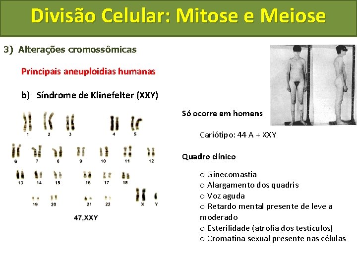 Divisão Celular: Mitose e Meiose 3) Alterações cromossômicas Principais aneuploidias humanas b) Síndrome de