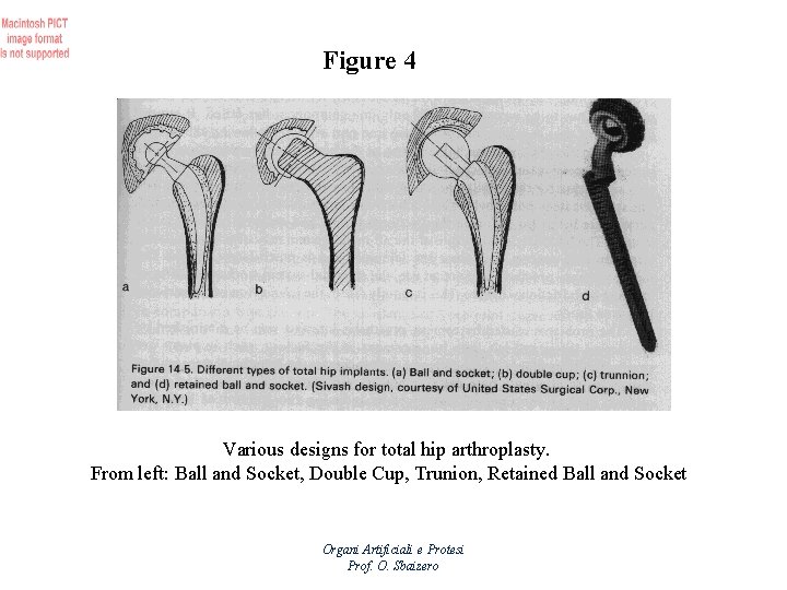 Figure 4 Various designs for total hip arthroplasty. From left: Ball and Socket, Double