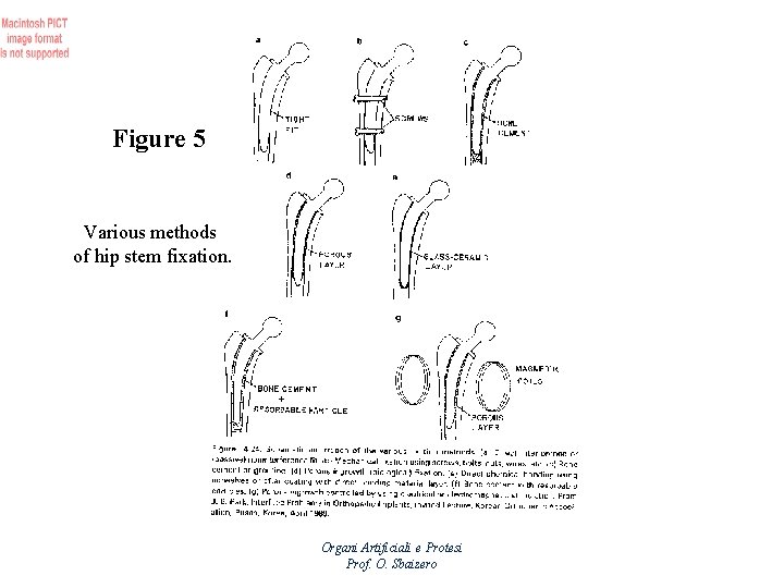 Figure 5 Various methods of hip stem fixation. Organi Artificiali e Protesi Prof. O.