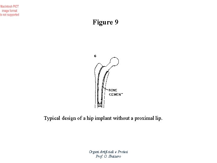 Figure 9 Typical design of a hip implant without a proximal lip. Organi Artificiali