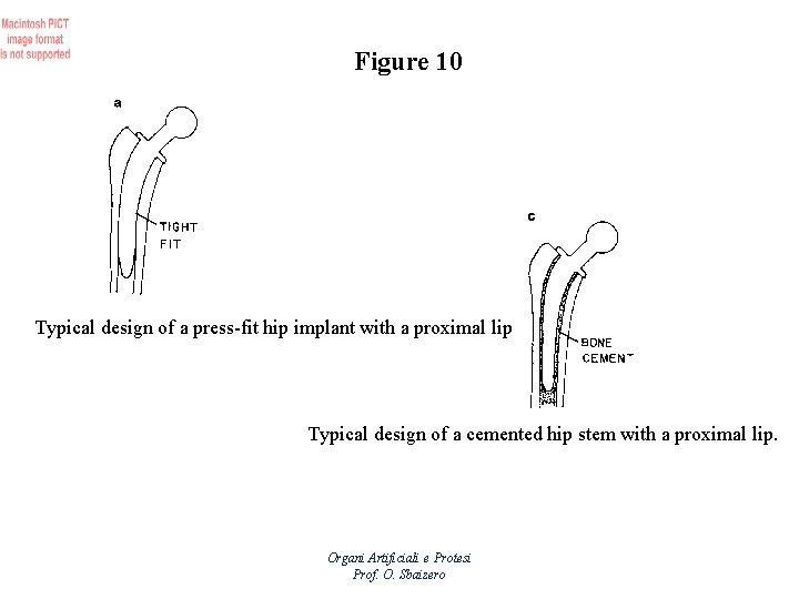 Figure 10 Typical design of a press-fit hip implant with a proximal lip Typical