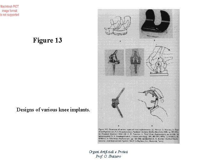 Figure 13 Designs of various knee implants. Organi Artificiali e Protesi Prof. O. Sbaizero