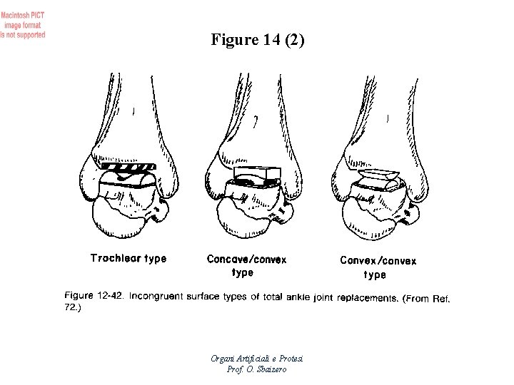 Figure 14 (2) Organi Artificiali e Protesi Prof. O. Sbaizero 