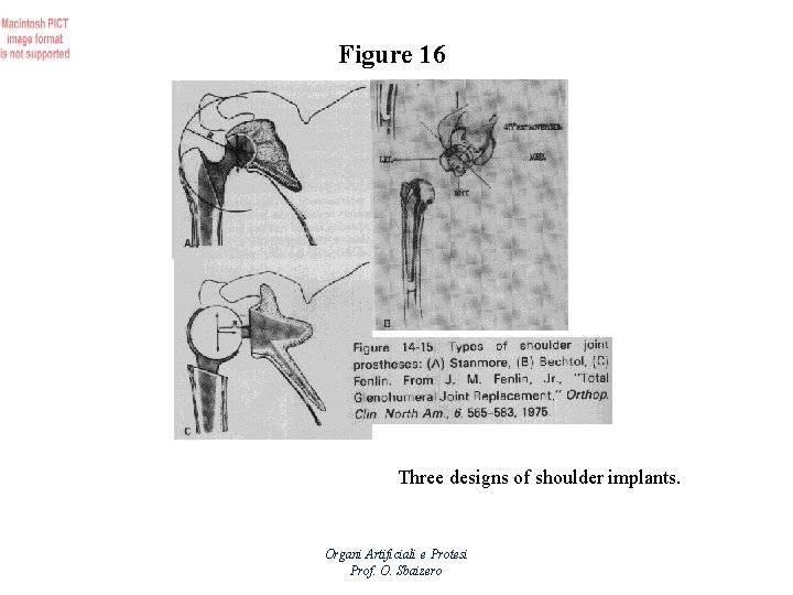 Figure 16 Three designs of shoulder implants. Organi Artificiali e Protesi Prof. O. Sbaizero