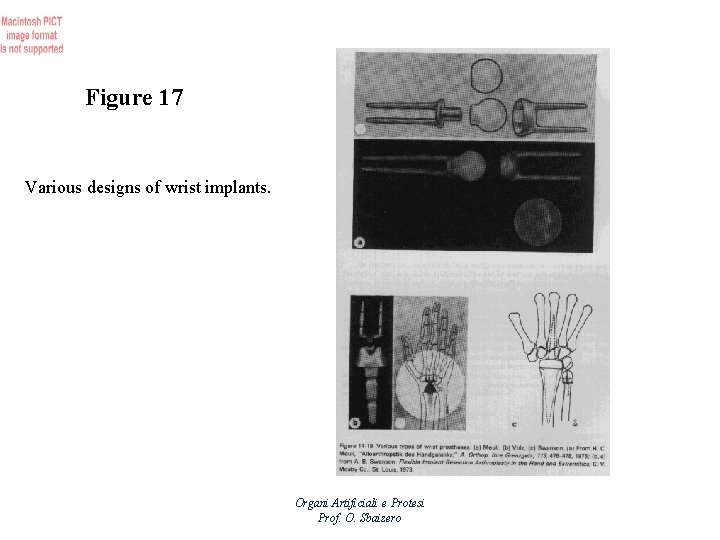 Figure 17 Various designs of wrist implants. Organi Artificiali e Protesi Prof. O. Sbaizero