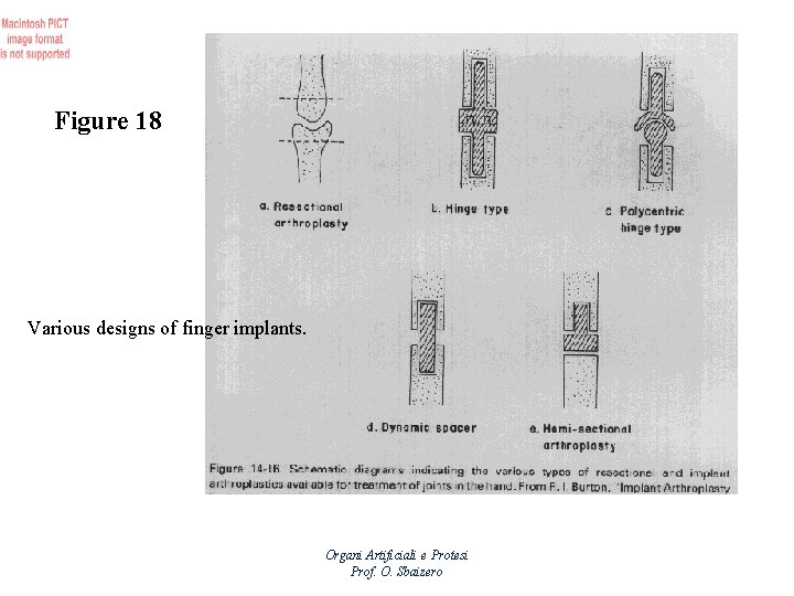 Figure 18 Various designs of finger implants. Organi Artificiali e Protesi Prof. O. Sbaizero