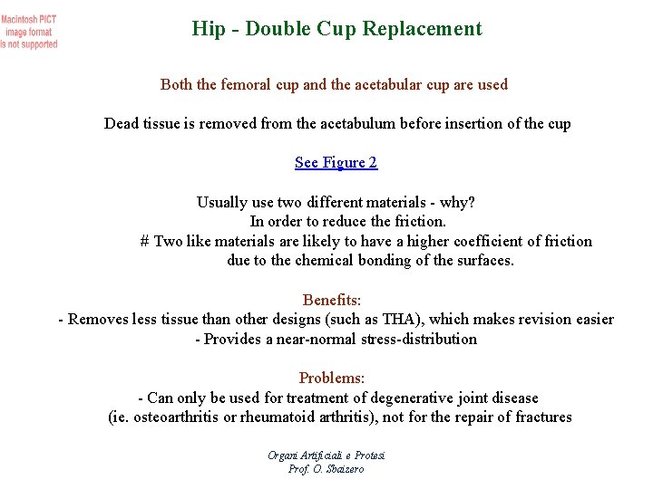 Hip - Double Cup Replacement Both the femoral cup and the acetabular cup are