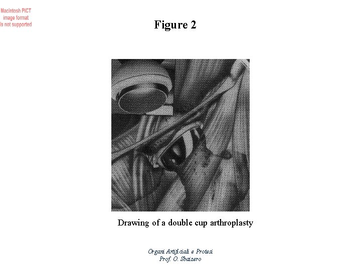 Figure 2 Drawing of a double cup arthroplasty Organi Artificiali e Protesi Prof. O.