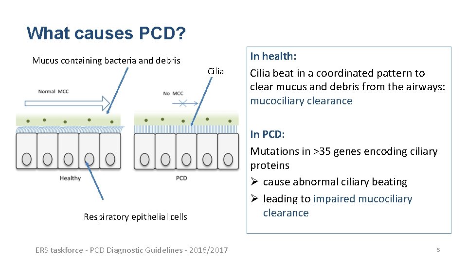 What causes PCD? Mucus containing bacteria and debris Cilia Respiratory epithelial cells ERS taskforce What causes PCD? Mucus containing bacteria and debris Cilia Respiratory epithelial cells ERS taskforce