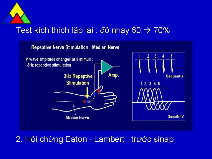 Test kích thích lặp lại : độ nhạy 60 70% 2. Hội chứng Eaton