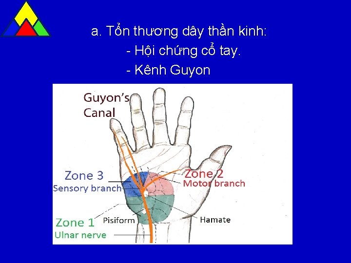 a. Tổn thương dây thần kinh: - Hội chứng cổ tay. - Kênh Guyon