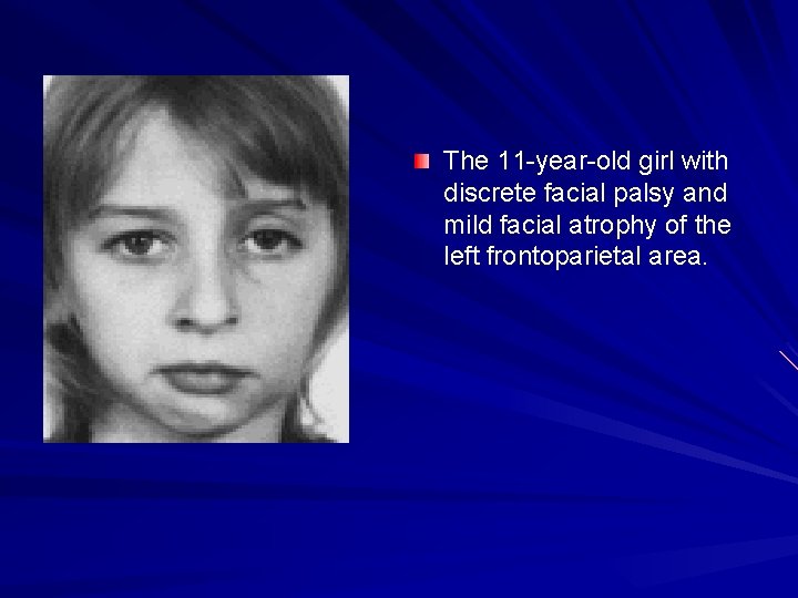 The 11 -year-old girl with discrete facial palsy and mild facial atrophy of the